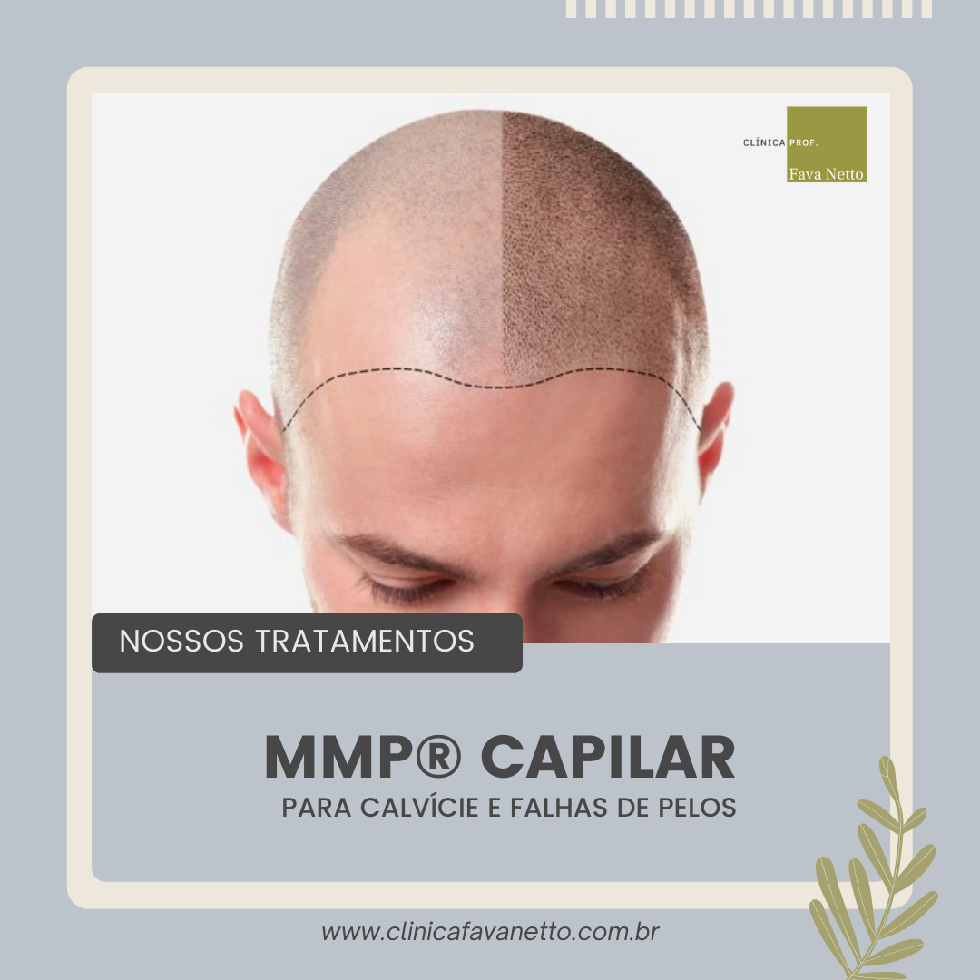 MMP® - Tratamento para calvície e falhas de pelos